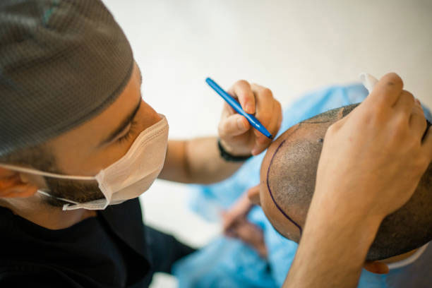 hair transplantation